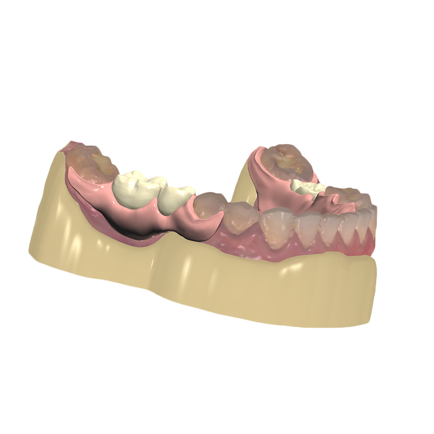 Removable Partial Denture Digital Dental Prosthetics