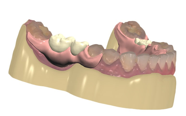 Removable Design Removable Partial Denture Design